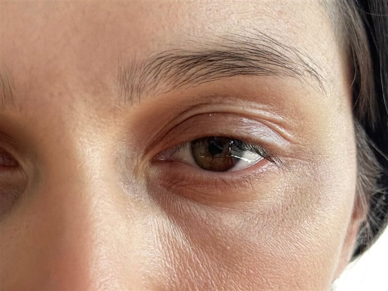 Downturned eye, reference photo
