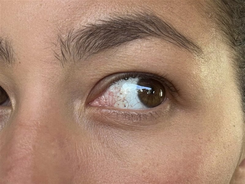 Protruding eye, reference photo